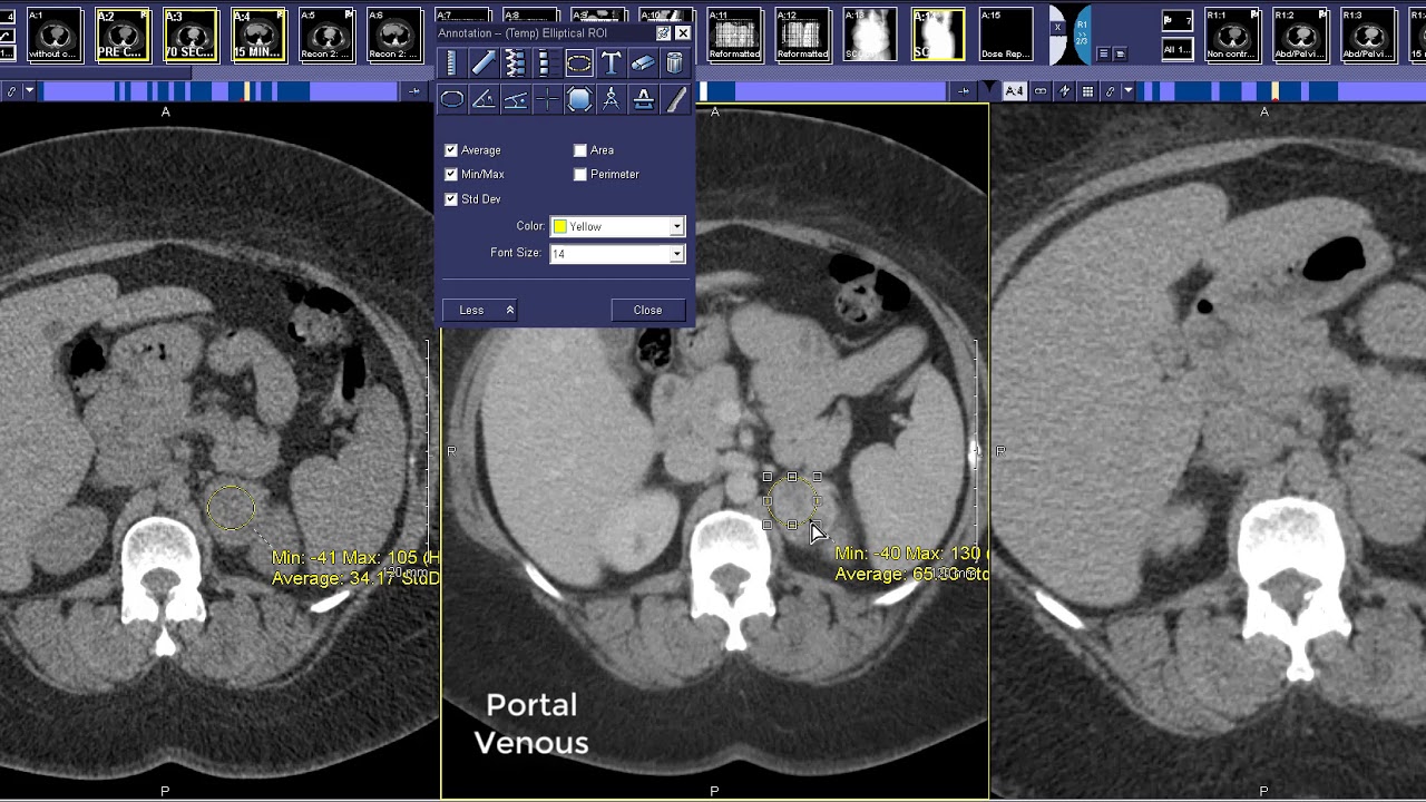 How to read an adrenal protocol CT scan - adrenal washout