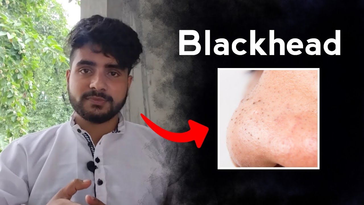 Blackheads हटाउने तरिका | How to remove blackheads at home | Nepali yogi