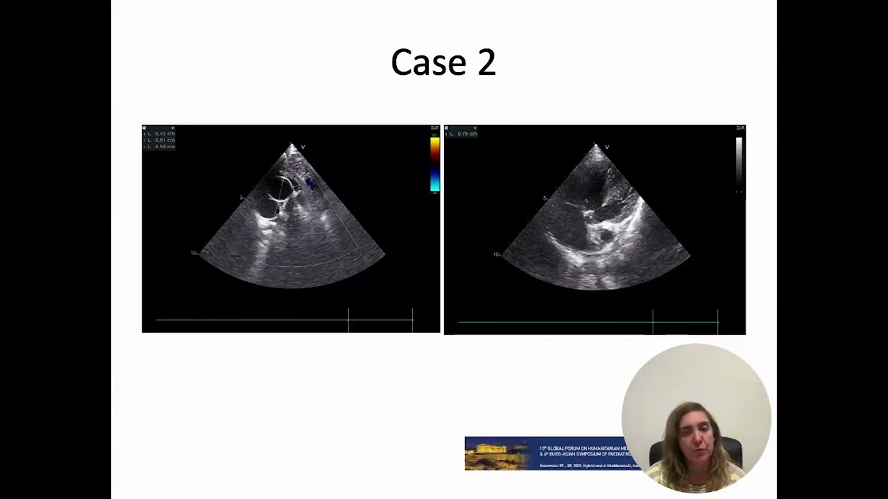GFHM 2025 LECTURES DAY 3 NEGLECTED CONGENITAL HEART DISEASE IN REFUGEES