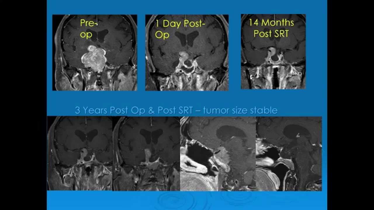 Radiation Therapy for Pituitary Tumors - Robert Wollman, MD