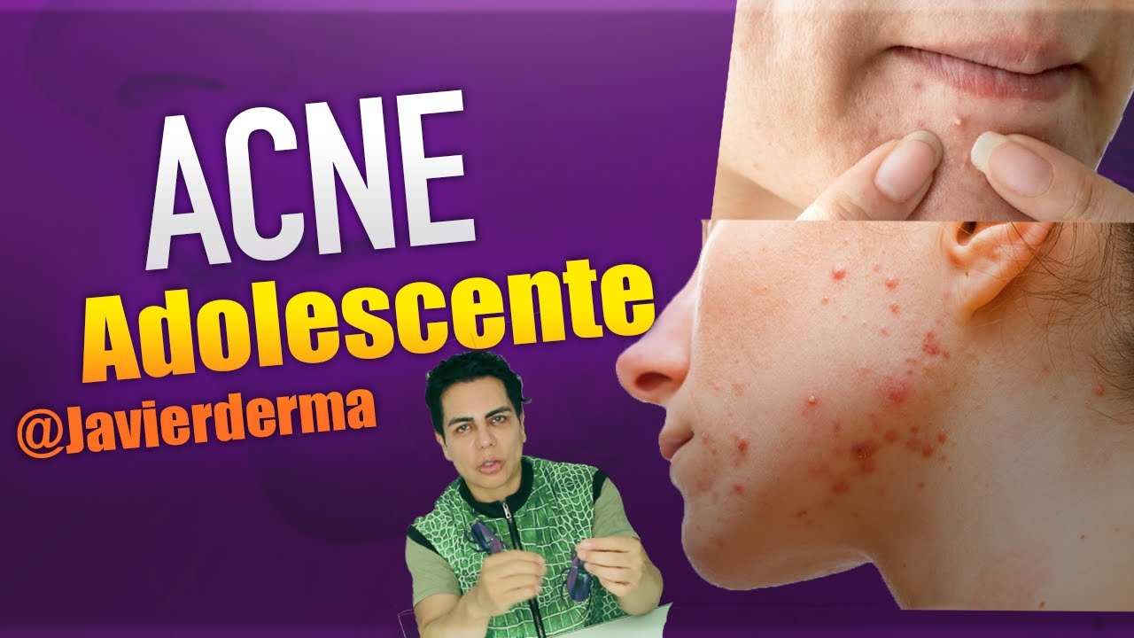 El acné adolescente / Como Quitar el Acné /Javierderma