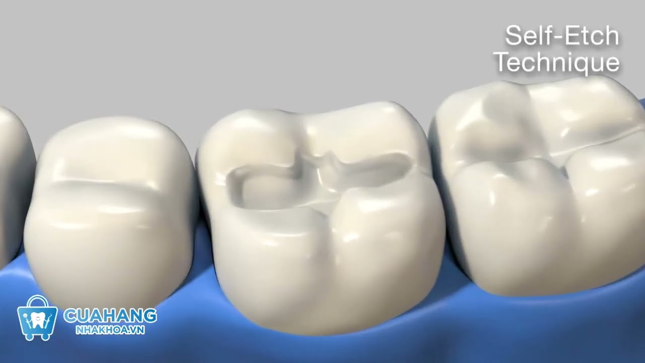 Hướng dẫn kỹ thuật Etching trong nha khoa