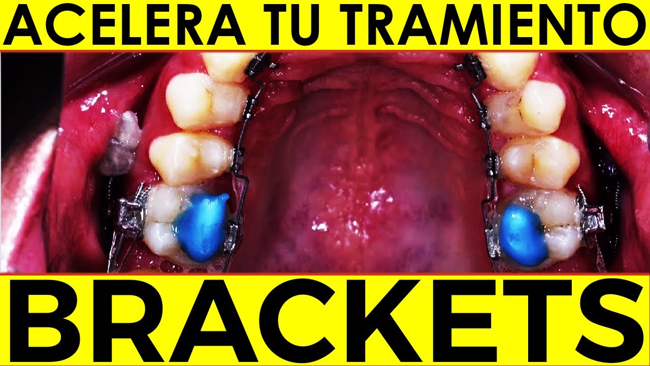 ¿Cuáles son los BENEFICIOS de USAR TOPES en los DIENTES durante tu TRATAMIENTO DE ORTODONCIA? TIPS