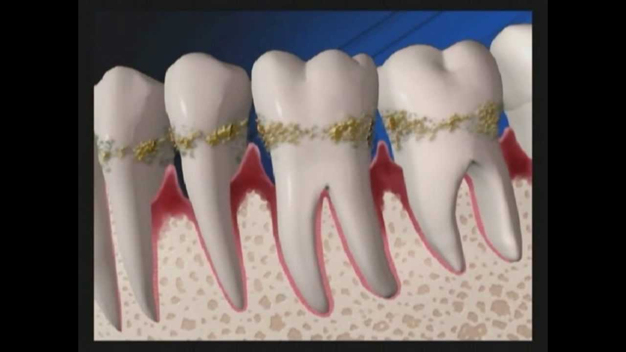 Ultrasonic Scaling for Periodontal Disease Treatment | Lake Merritt Dental, Oakland, CA