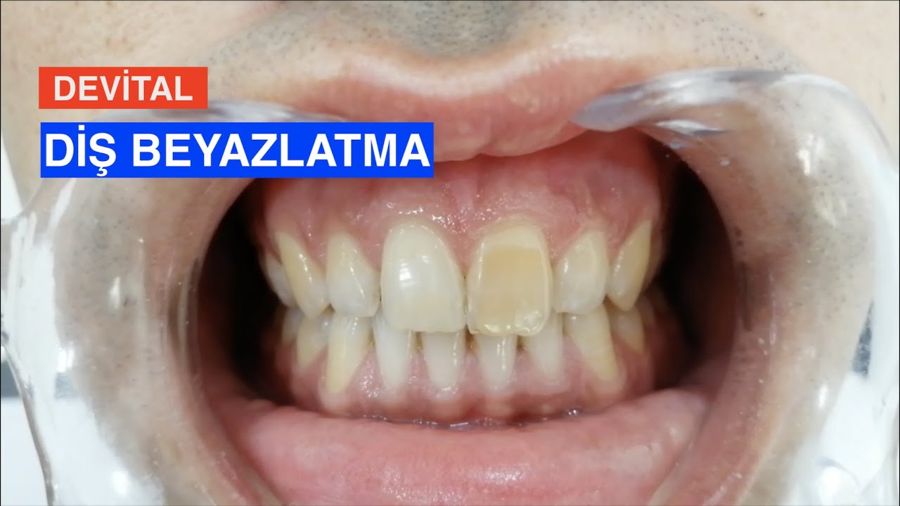 Devital Diş Beyazlatma