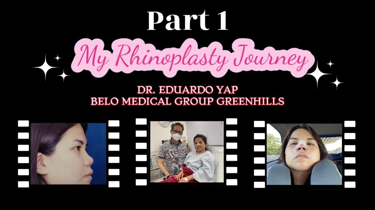 My Rhinoplasty Journey 👃🏻| Dr. Ed Yap Belo Medical Group 👨‍⚕️ | Yap Procedure #ayfertv #nosejob