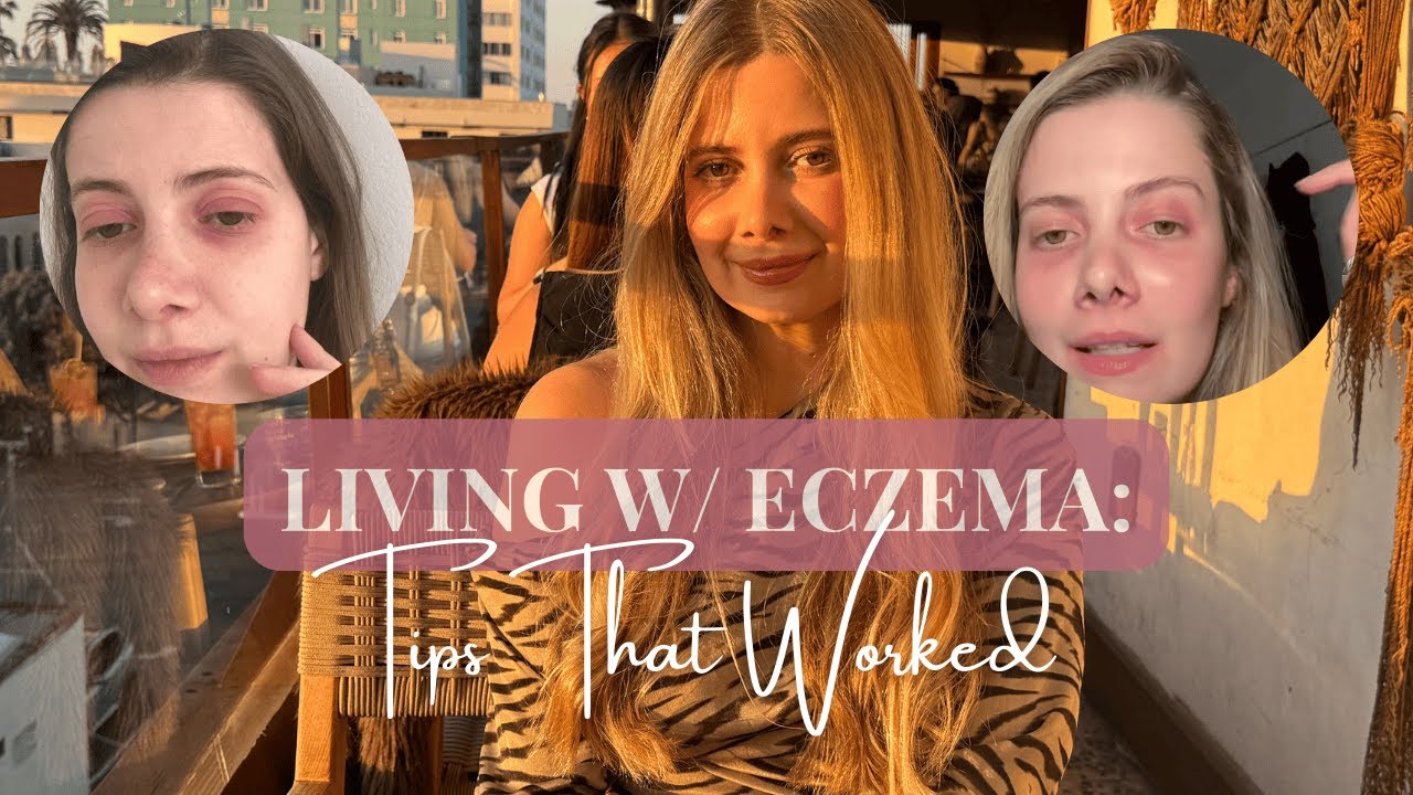What Finally Helped Me Get My Eczema Under Control (My Honest Journey)