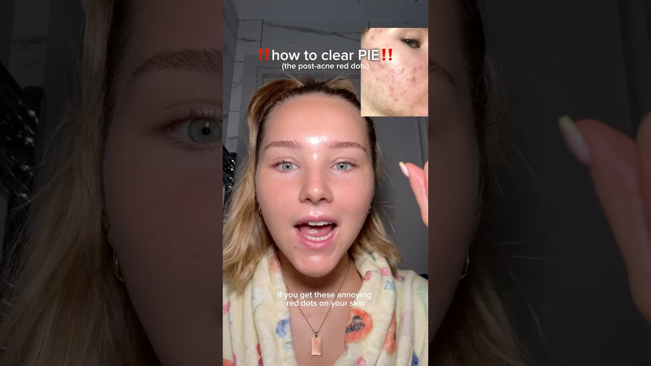 how to GET RID of ACNE MARKS‼️