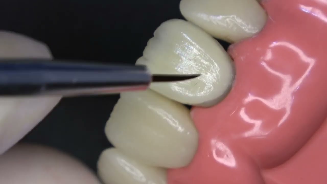 Resina Composta em Dentes Escurecidos - Técnica Direta/Indireta