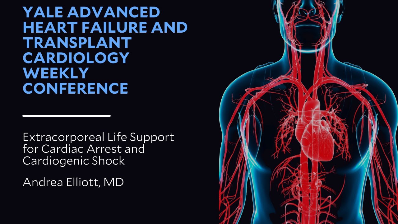 Extracorporeal Life Support for Cardiac Arrest and Cardiogenic Shock