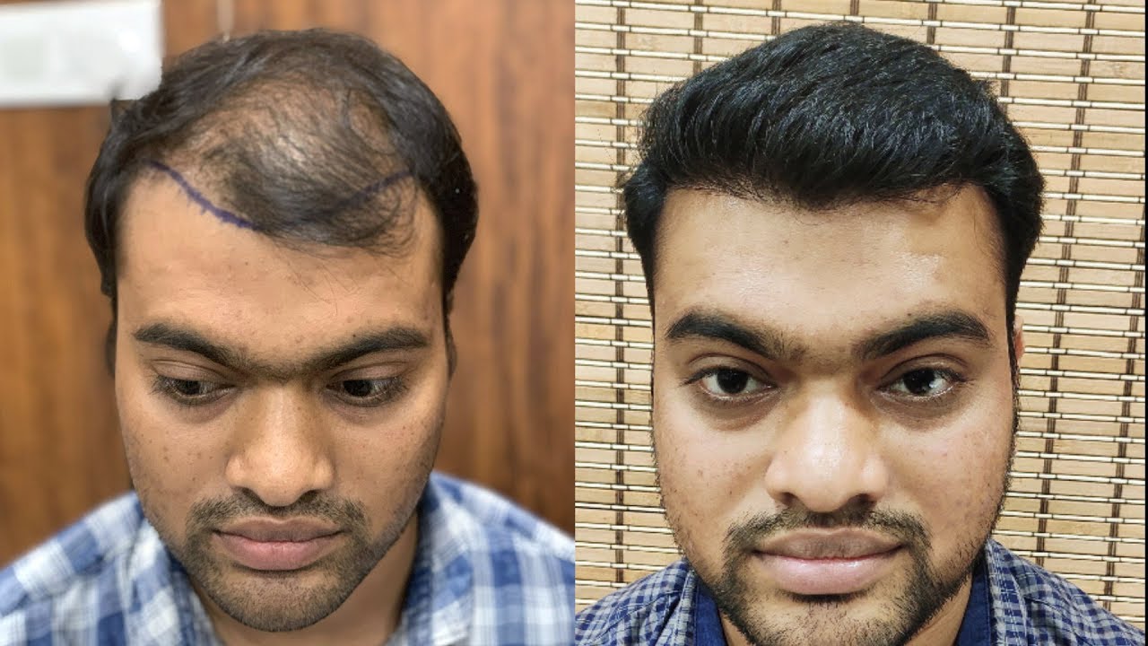 Hair Transplant In India | Hair Transplant Results
