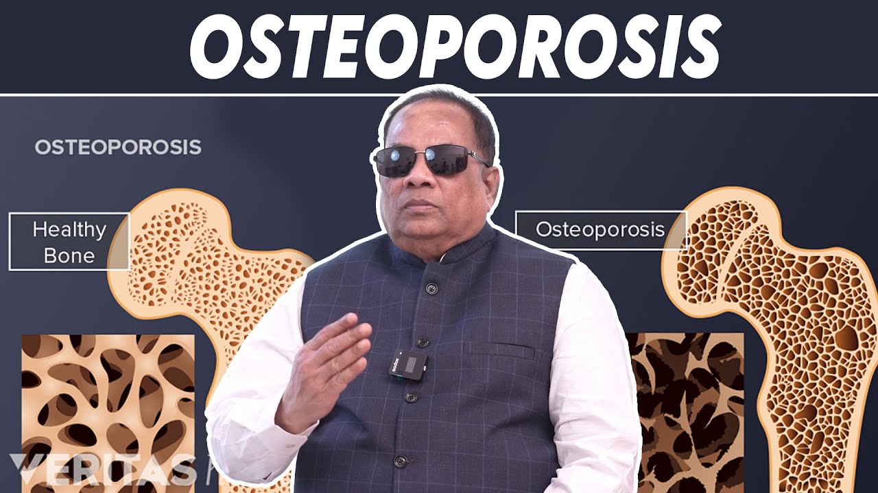 OSTEOPOROSIS / CKN