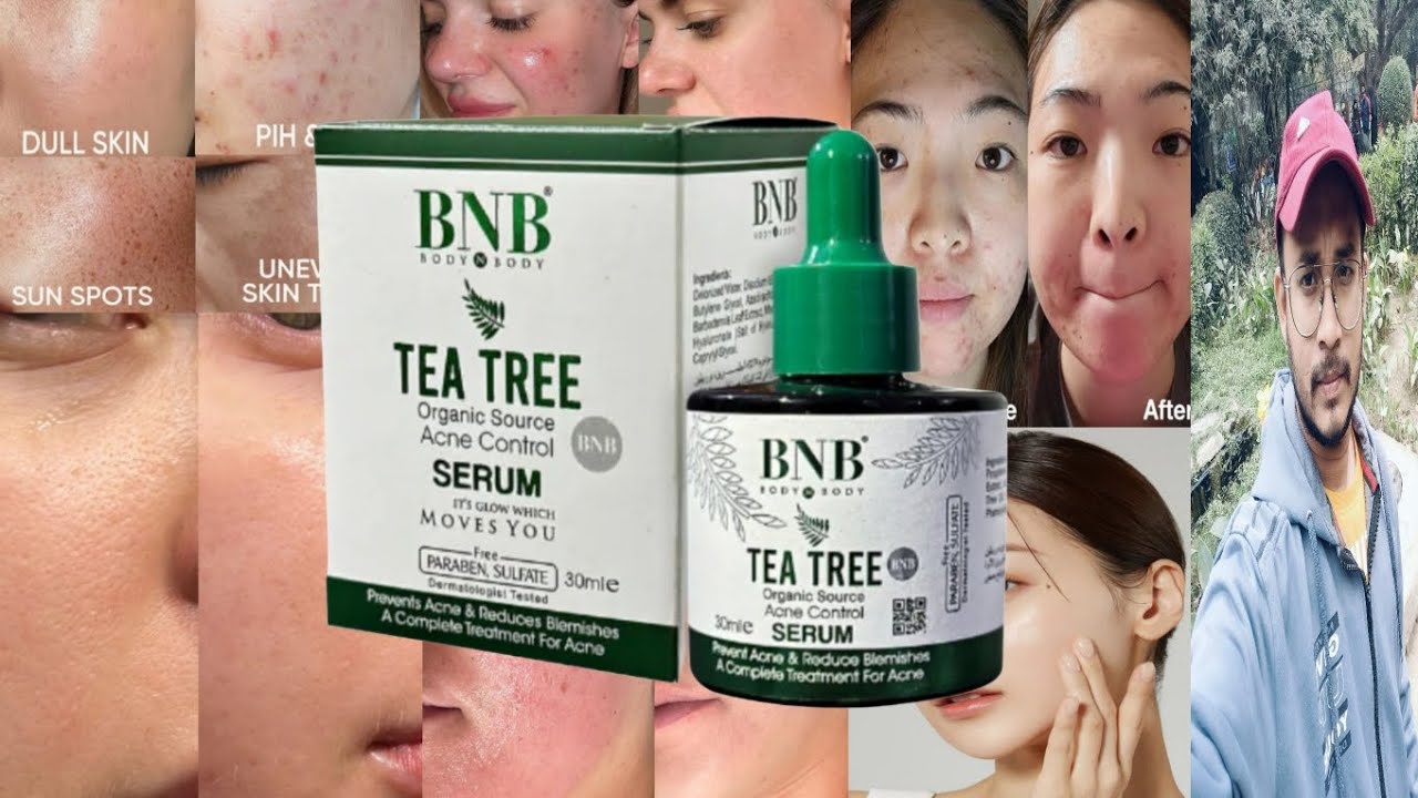 BNB Tea Tree Acne Control Serum | Honest Review
