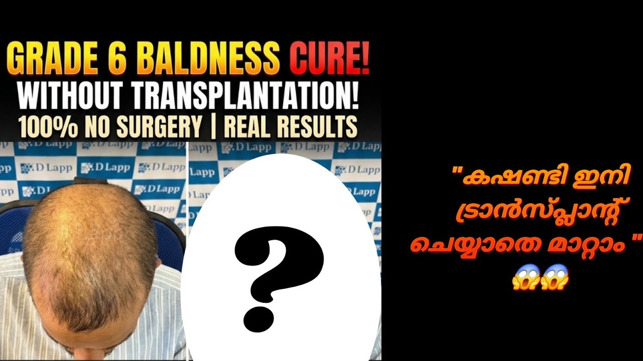 Grade 6 Baldness cure! NO TRANSPLANTATION | NO SURGERIES |100%GENUINE #dlapp #hairgrowth 