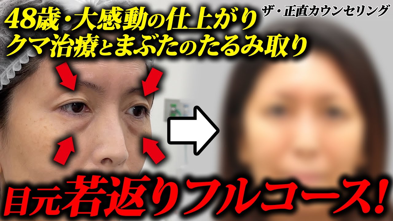 【クマ取りで若返り】大変身！上まぶたも下まぶたも目周り一気に若返り｜みゆきの技術全投入