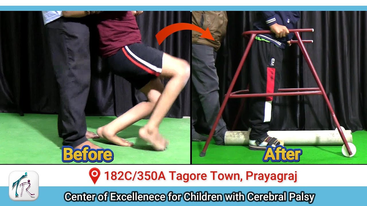 A cerebral palsy Child with bent knee needs surgery followed by intensive therapy