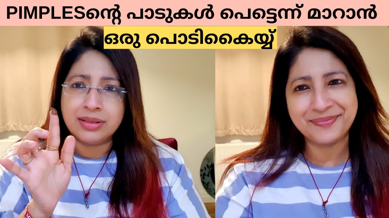 മുഖക്കുരു കര എന്നിവയുടെ പാടുകൾ മാറാൻ ഇനി ഇങ്ങനെ ചെയ്യൂ || EASY DIY FOR REMOVING PIMPLE SCARS