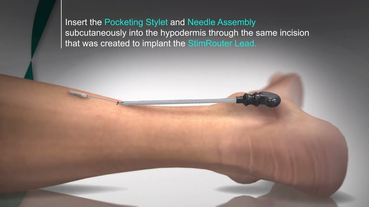 TalisMann Procedure Video