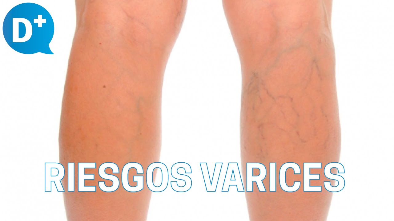 ¿Existen riesgos al tratar las varices?
