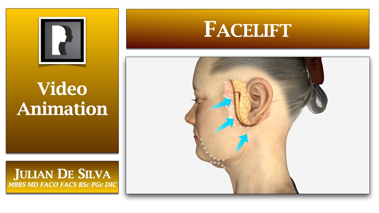 Facelift & Neck Lift Surgical Procedure: 3D medical animation by Dr Julian De Silva