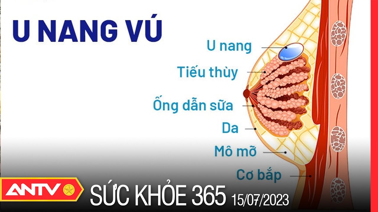 Chuy&ecirc;n gia n&oacute;i về triệu chứng v&agrave; c&aacute;ch điều trị bệnh u nang tuyến v&uacute; | Sức khỏe 365 | ANTV
