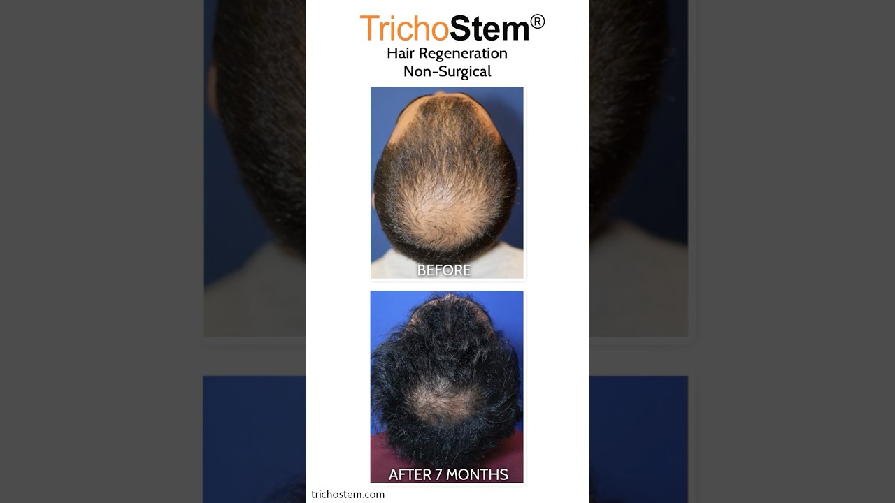 Dormant Hair Follicles Reactivated for Hair Regrowth #hairloss