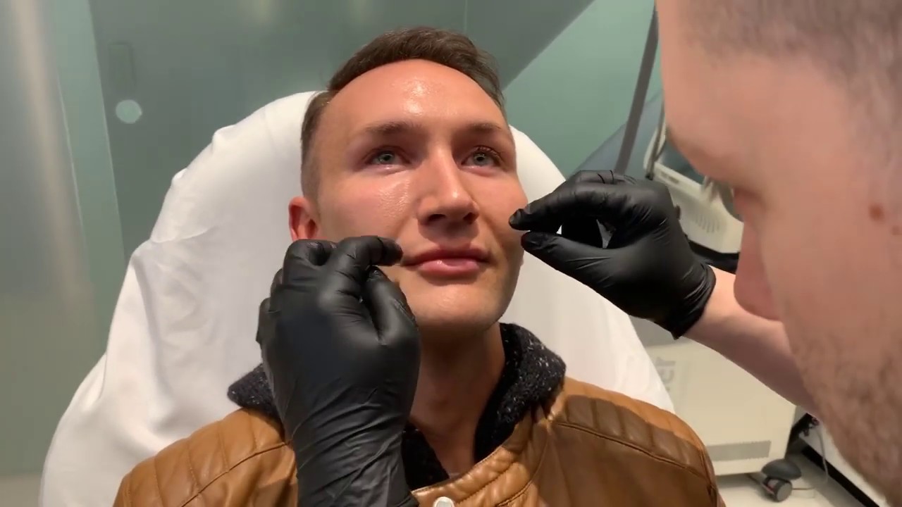 Male Lip Enhancement | Juvederm Volbella | West Hollywood, CA | Dr. Jason Emer