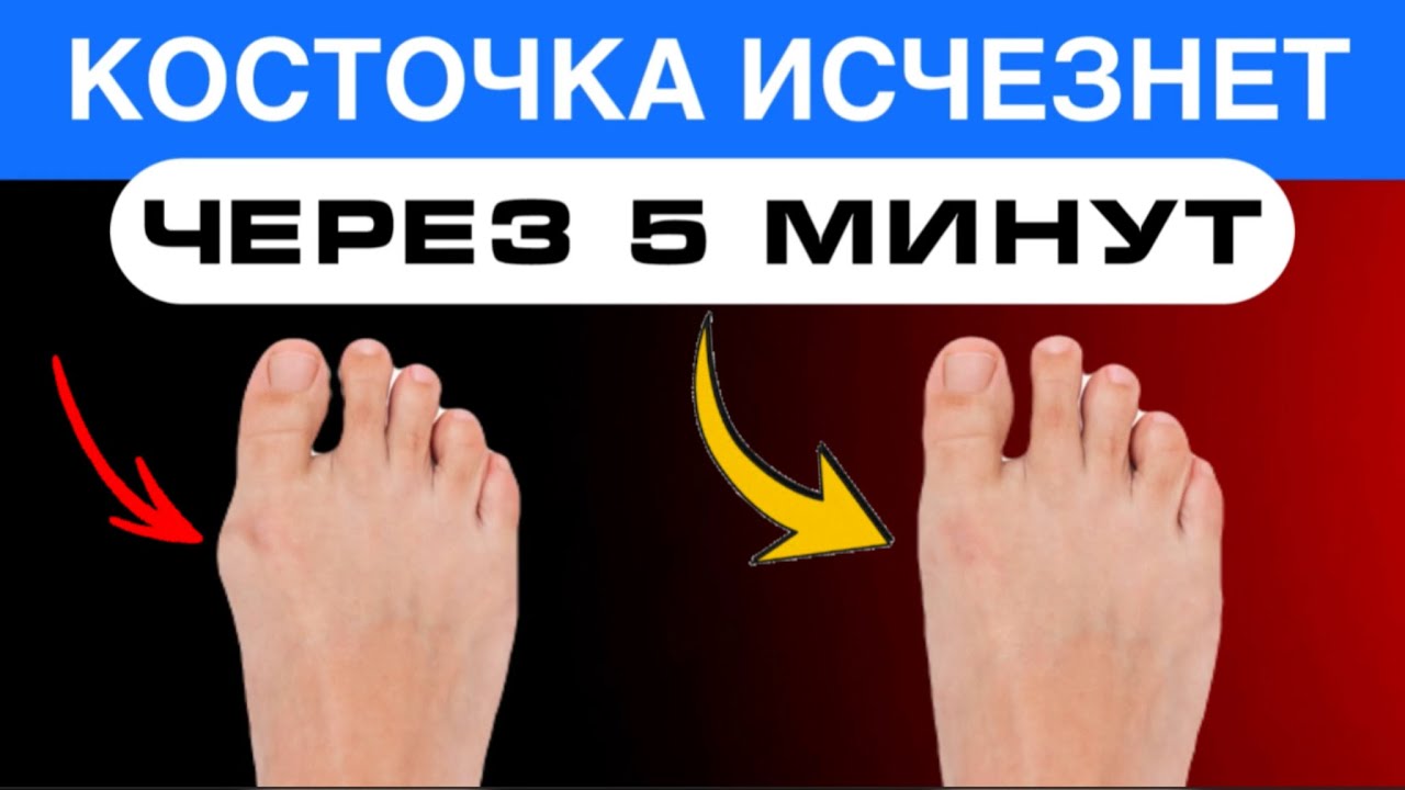 КОСТОЧКА на большом пальце ноги исчезнет НАВСЕГДА. Нужно расслабить эти мышцы 