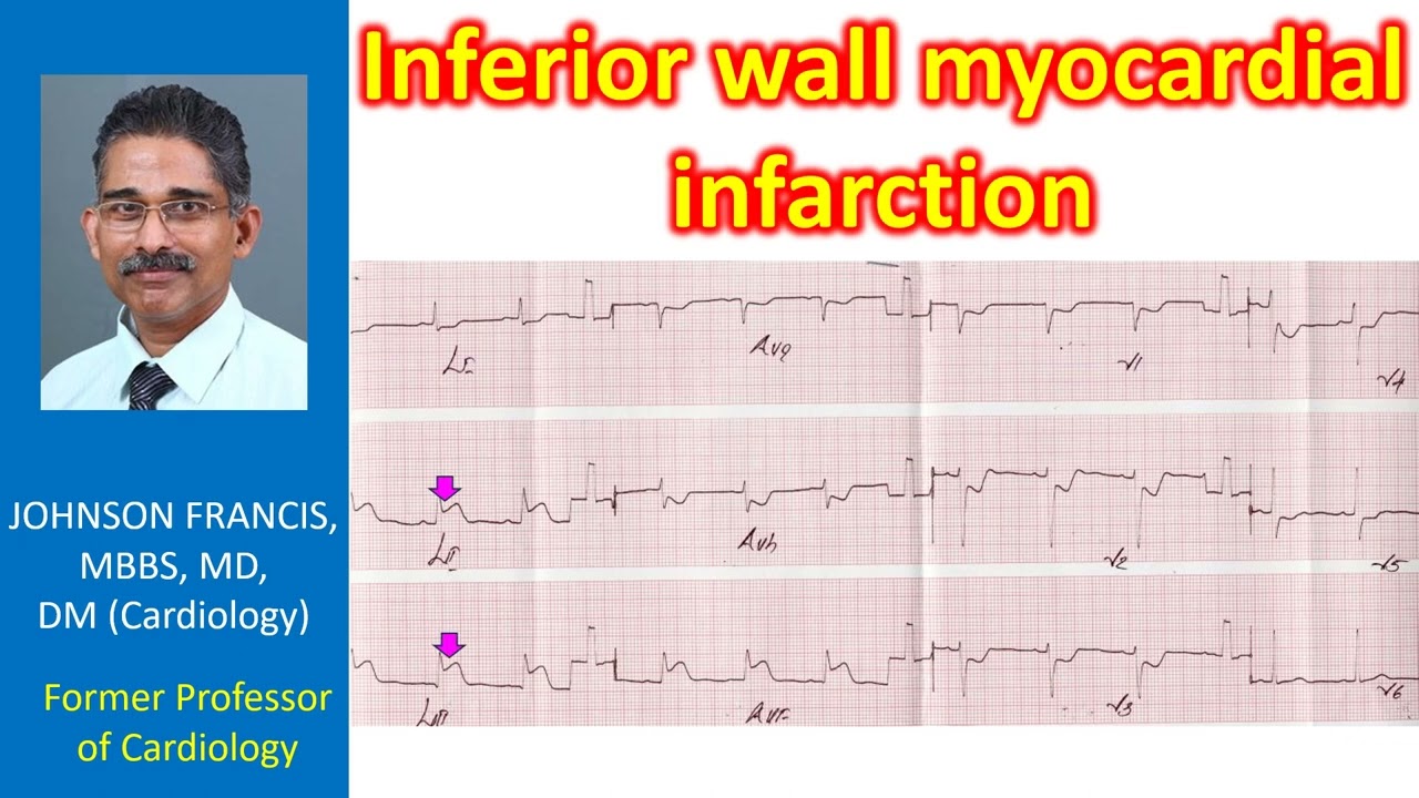 Inferior wall myocardial infarction
