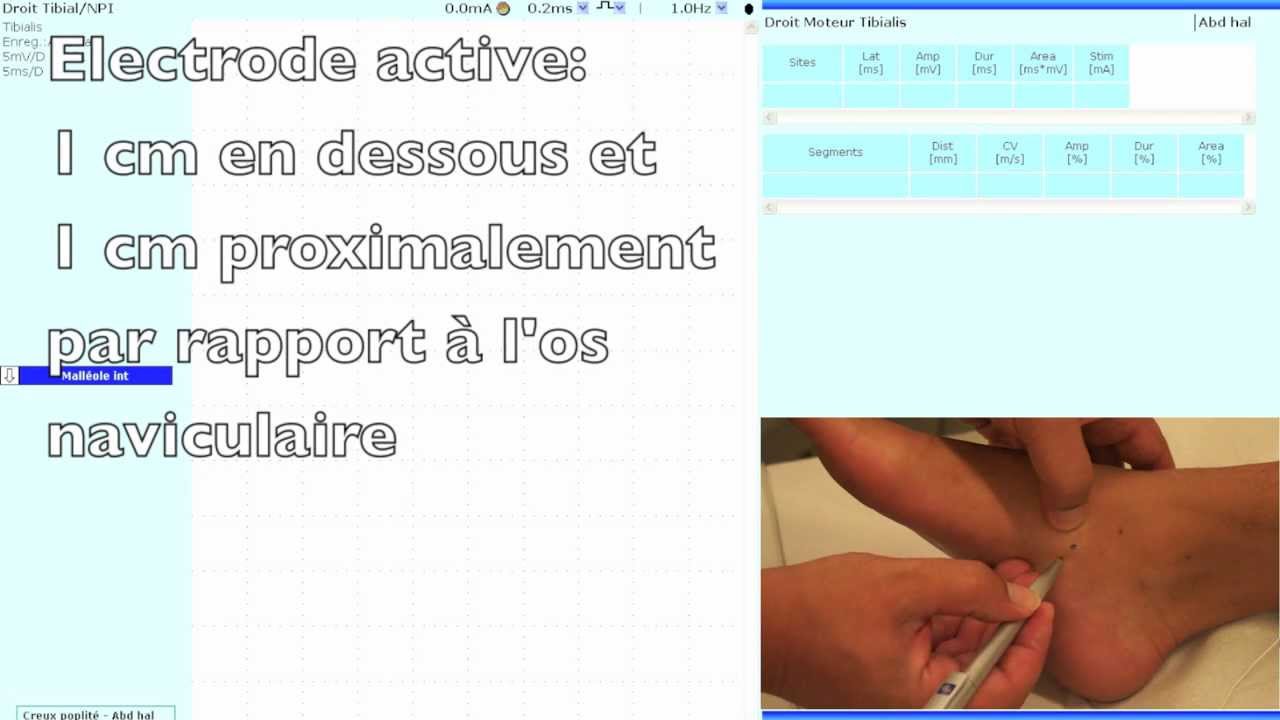 Nerf tibial (neurographie motrice : r&eacute;ponses M et F)