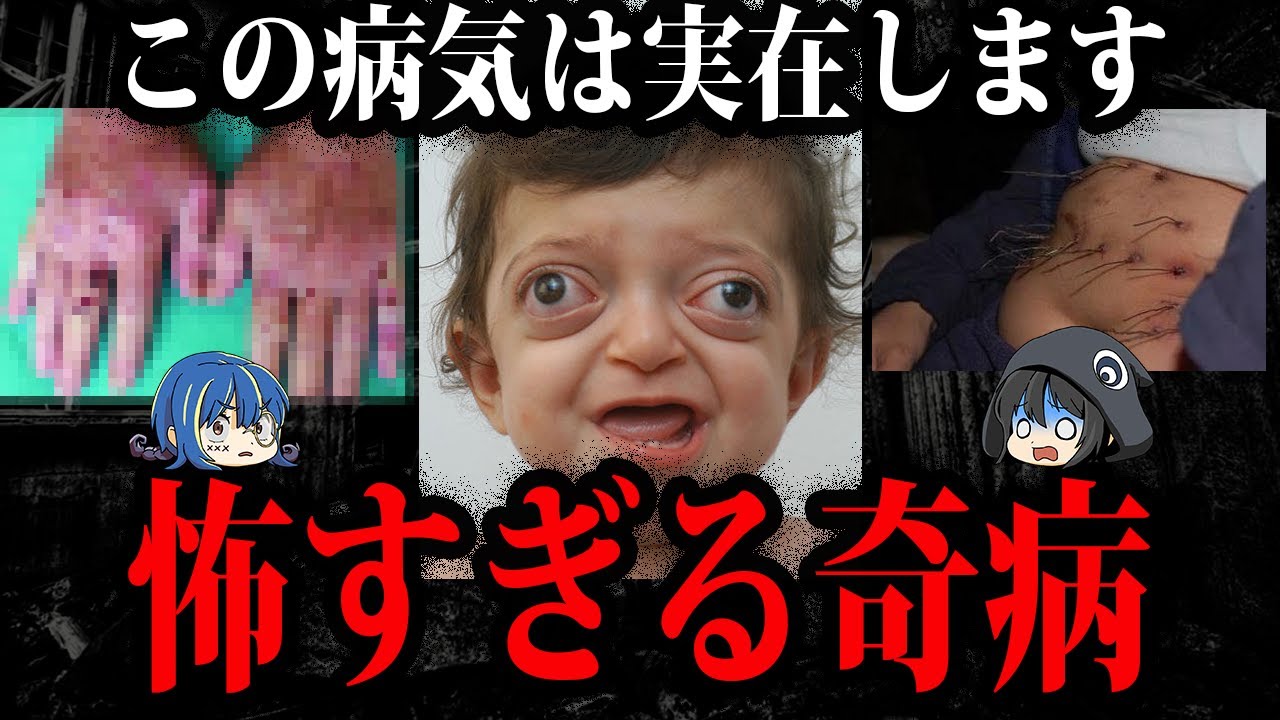 この病気は実在します。世界の怖すぎる奇病７選