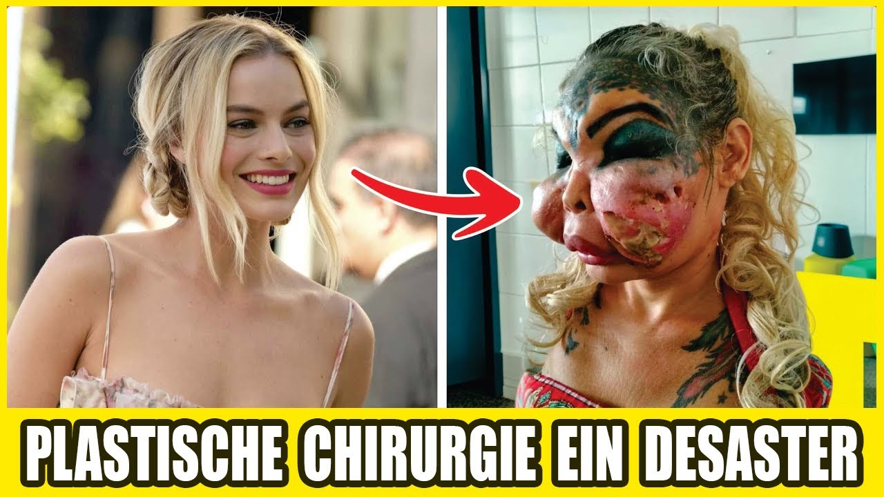 30 Gesichter, Die Durch Sch&ouml;nheitsoperationen Zerst&ouml;rt Wurden | Vorher & Nachher 2026!