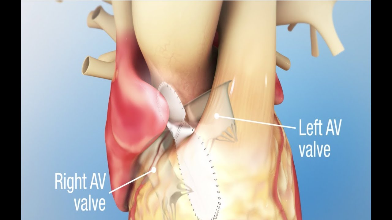 Atrioventricular (AV) Septal Defect Repair