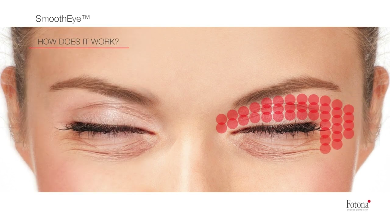 Figurra Fotona SmoothEye Laser Treatment