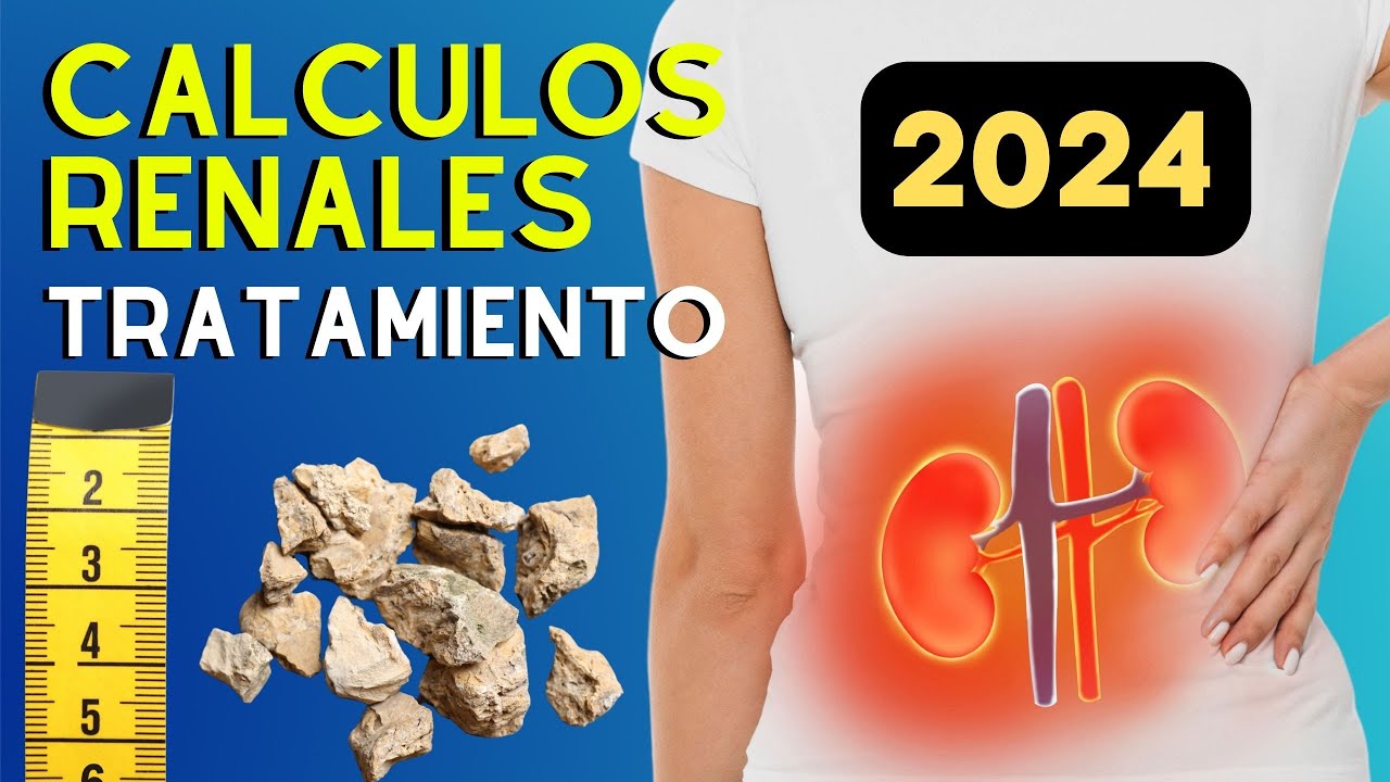 🪨 𝗖𝗔𝗟𝗖𝗨𝗟𝗢𝗦 𝗥𝗘𝗡𝗔𝗟𝗘𝗦: Causas, Diagnostico y Tratamiento de la Litiasis renal 2024