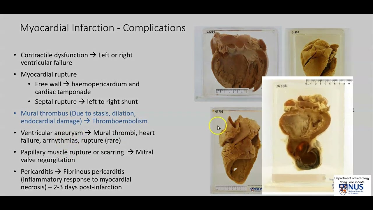 Heart: Myocardial infarction with mural thrombus (Gross pathology)