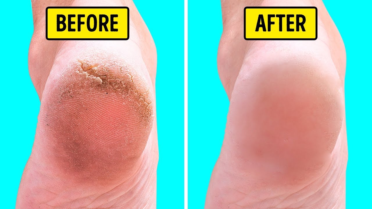 10 Natural Home Remedies for Silky Smooth Feet