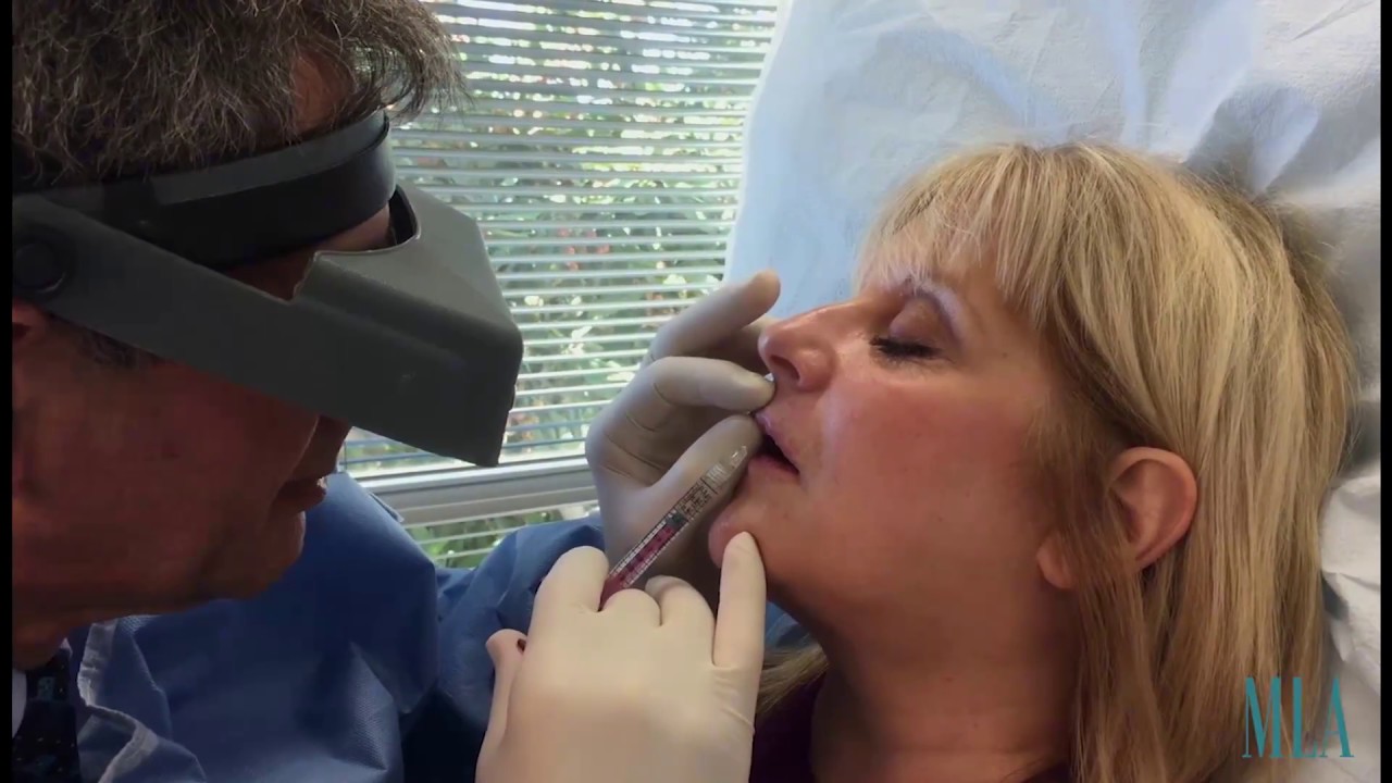 Juvederm Volbella Lip Filler | Santa Monica | Dr. George Anterasian