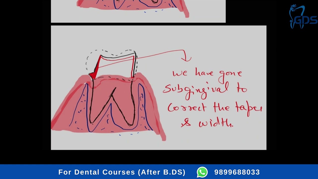 Why #dental  Crown Comes Out? Failures in FPD Tooth preparation - Loss of Retention
