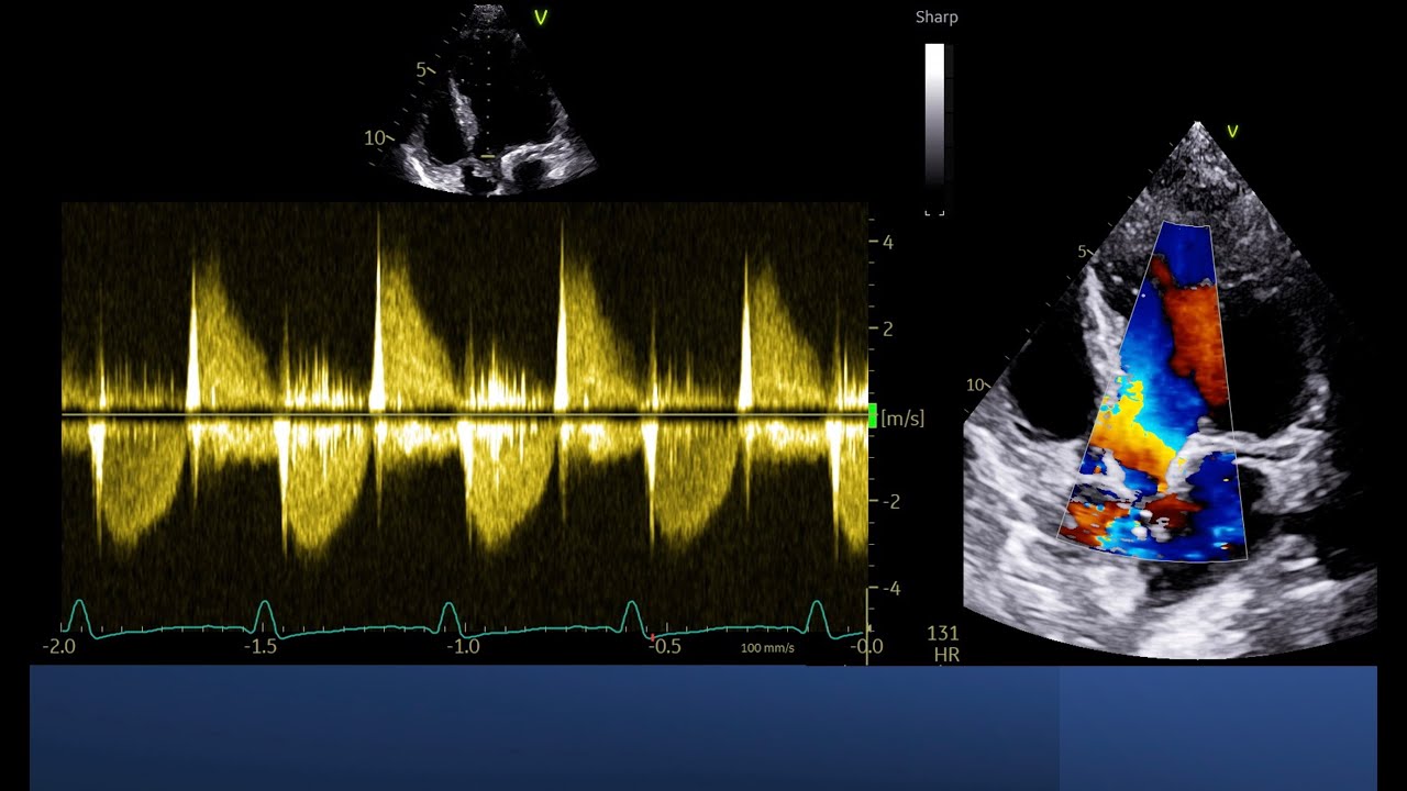 Color doppler is not enough to assess Severity of aortic Regurgitation.