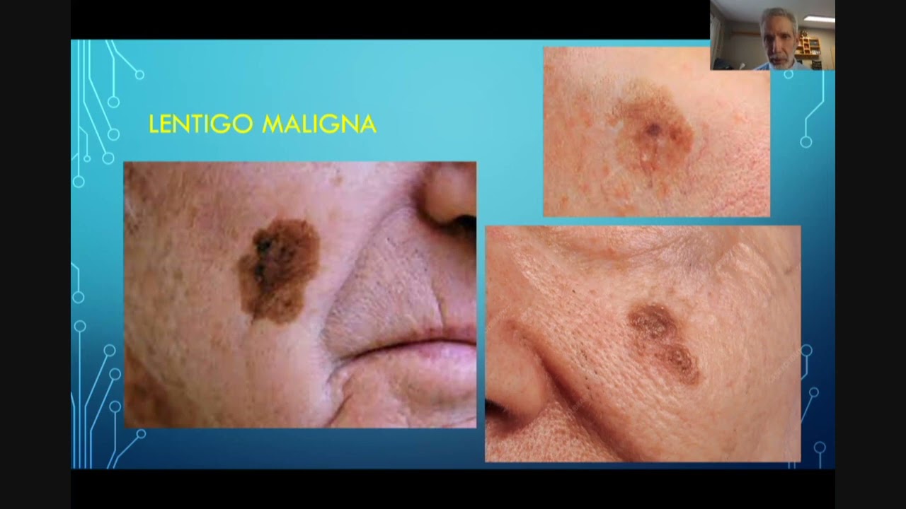 Dr. Gerald Boey - Treating pigmented lesions by laser