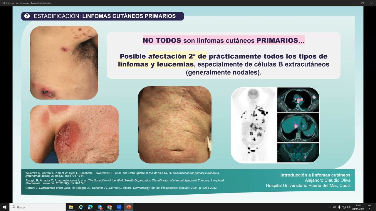 INTRODUCCION A LOS LINFOMAS CUTANEOS