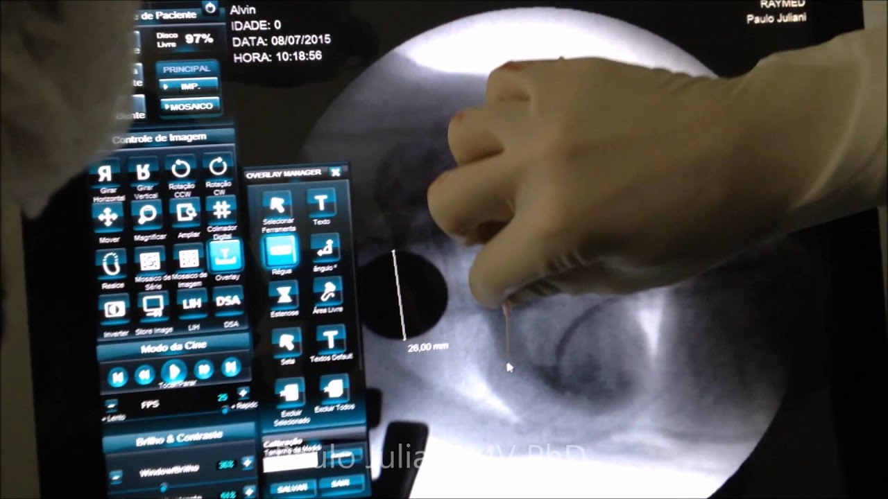 Pulmonic Stenosis - Valvuloplasty in a Dog