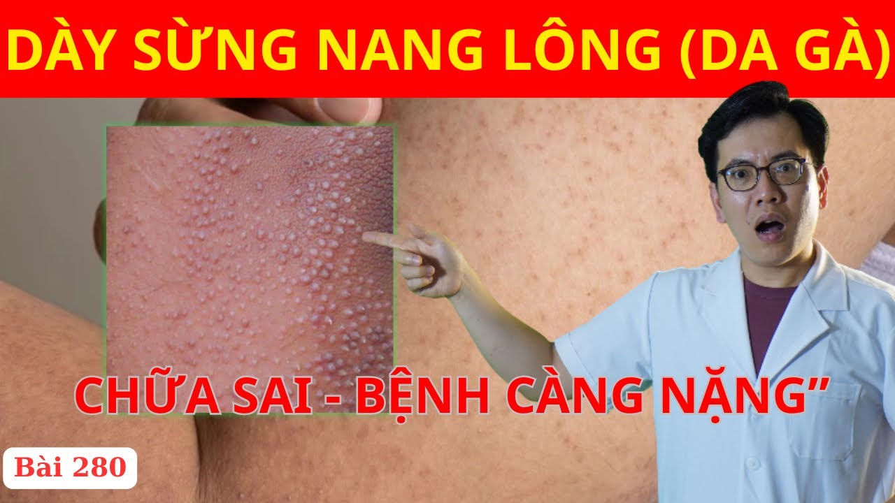 Dày Sừng Nang Lông (Da Gà): 90% Người Chữa Sai Cách Khiến Bệnh Ngày Càng Nặng | Ds Nguyễn Quốc Tuấn