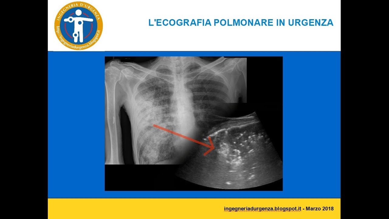 Ecografia polmonare in urgenza