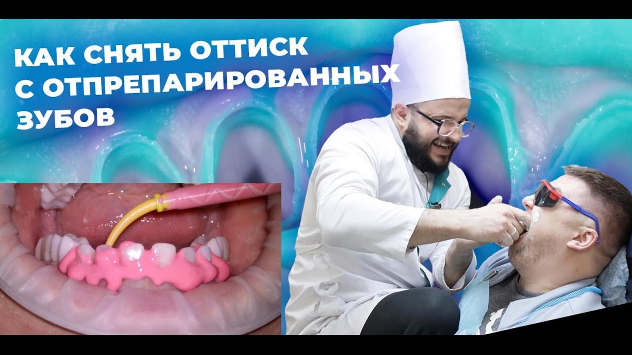 ОРТОПЕДИЧЕСКАЯ СТОМАТОЛОГИЯ КАК СНЯТЬ ОТТИСК