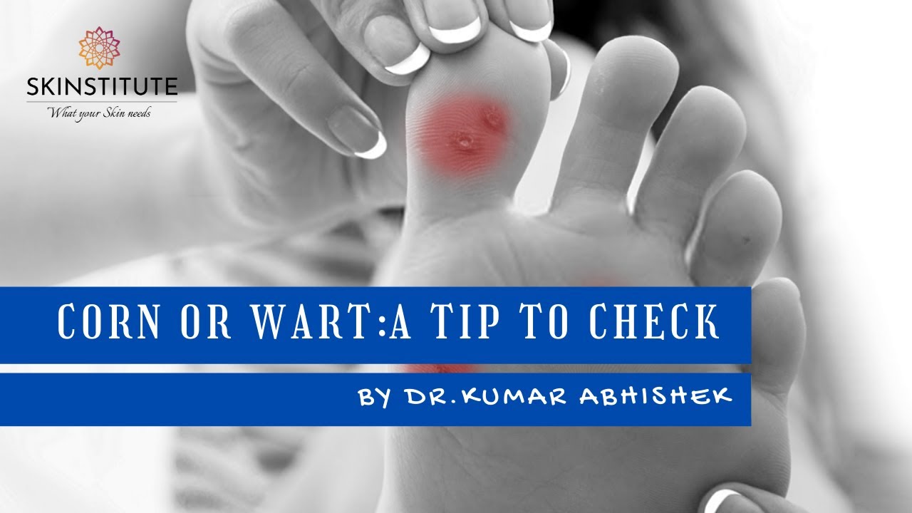 CORN OR WART- A TIP TO CHECK