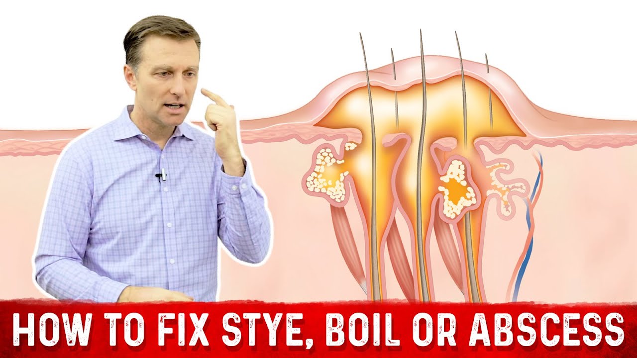 The Deeper Cause of an Eye Stye, Boil or Abscess &ndash; Eye Infection Stye &ndash; Dr.Berg