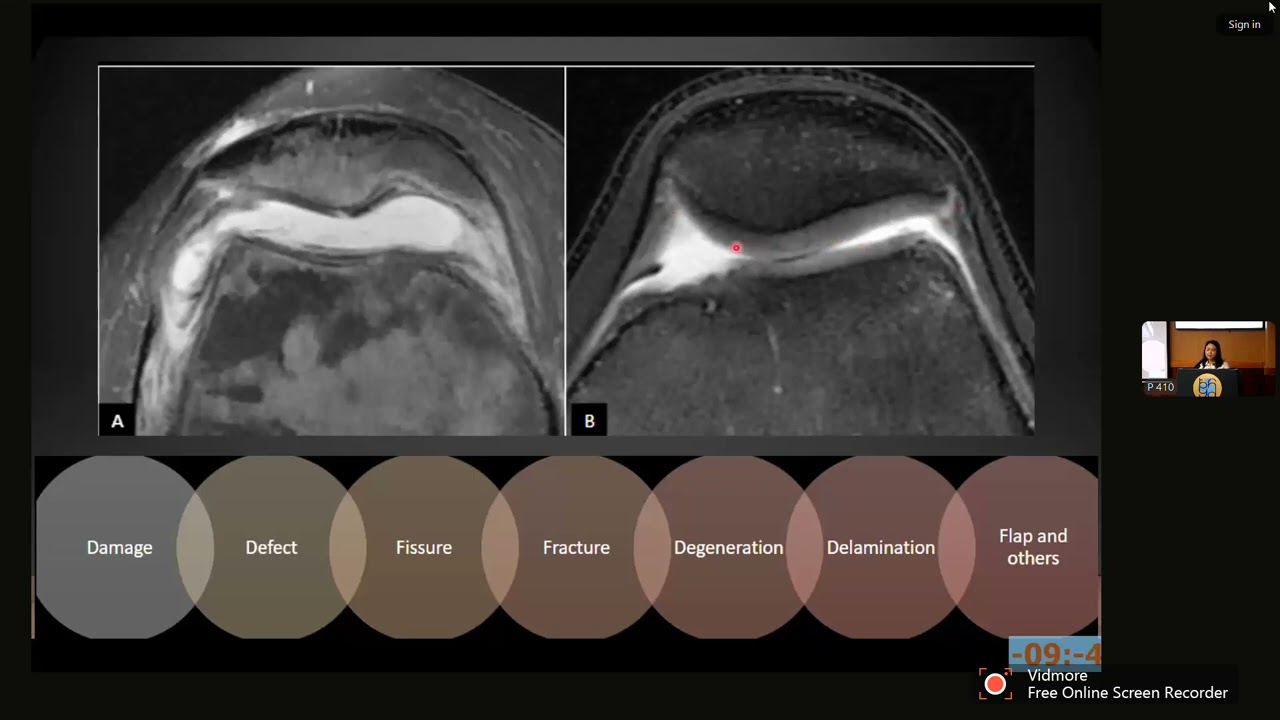 TỔN THƯƠNG KHỚP GỐI thường gặp trên MRI | TS. BS. VÕ PHƯƠNG TRÚC
