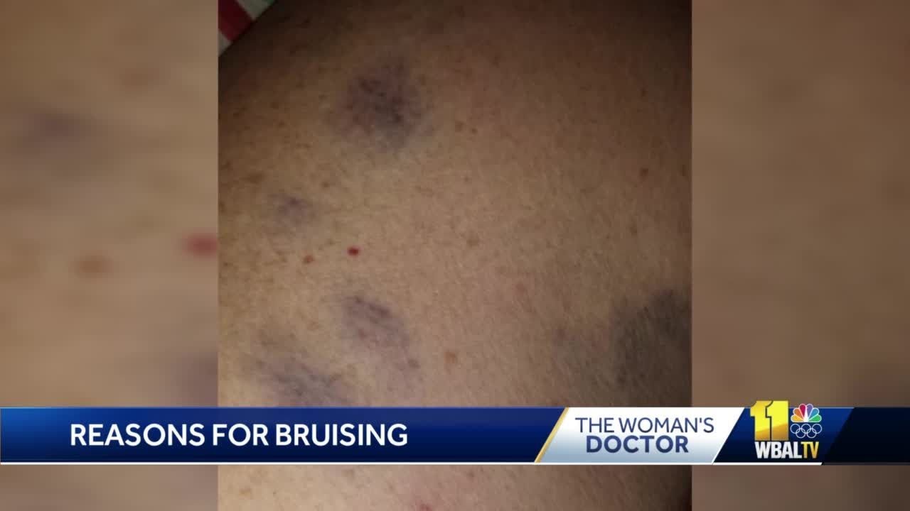The Woman's Doctor: Different reasons for bruising on the skin